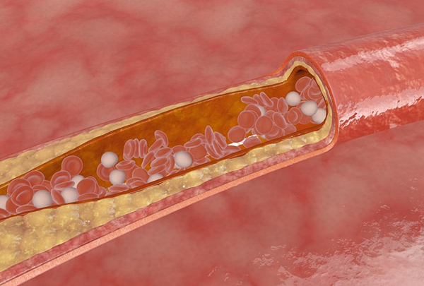 动脉硬化是如何形成的？又该怎样预防呢？